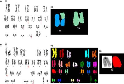 Impact of Additional Chromosomal Aberrations on the Disease Progression of Chronic Myelogenous Leukemia